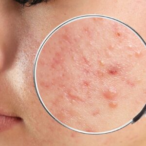 tratamiento acne palma de mallorca